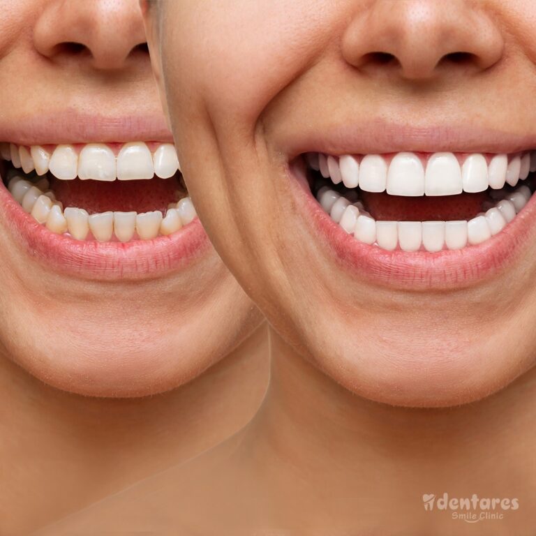 Full Set Of Veneers In Turkey