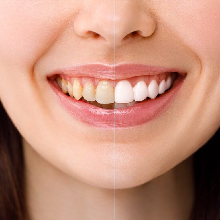 Dental center turkey teeth whitening