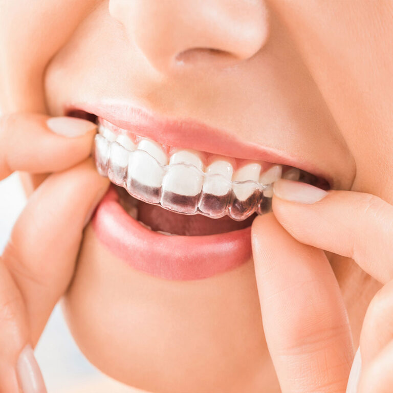 Aligners (Invisalign)