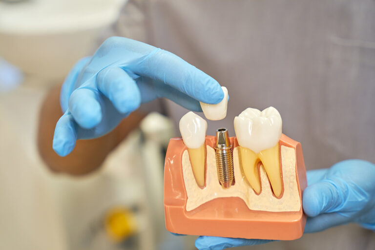 DentalImplants