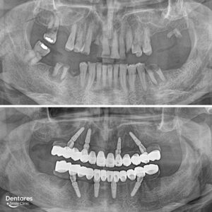 Slide-All-On-Implants