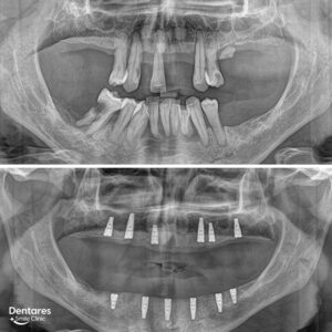 Slide-All-On-Implants