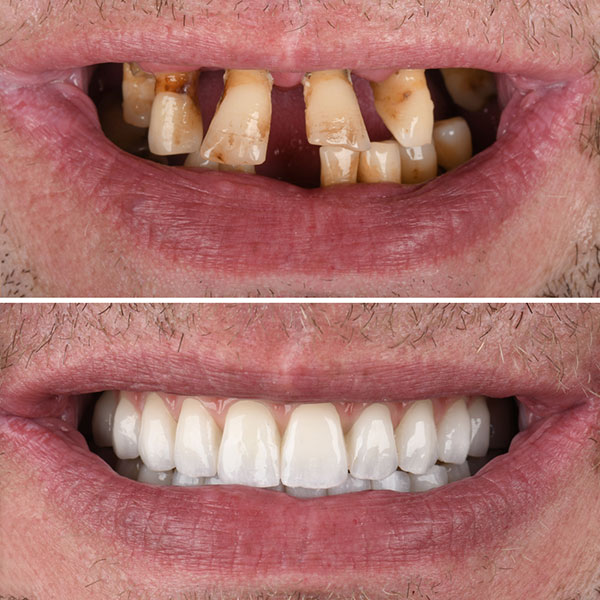 Tooth-Extraction-BoneLoss-Extractions-Allon4Turkey-StraumannDentalImplants-Swiss-NaturalSmileDesign